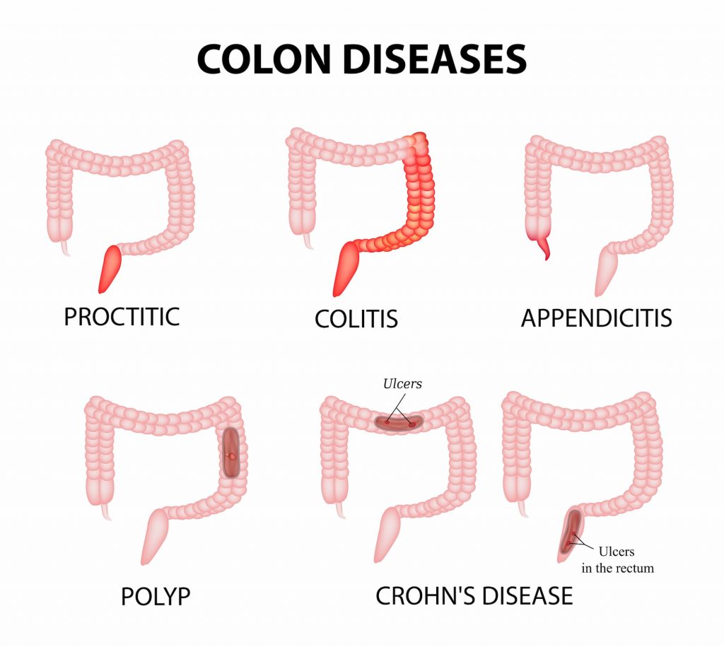 Ulcerative Colitis Diets: Nutrition for UC, IBD & Crohn's Disease - Dr ...